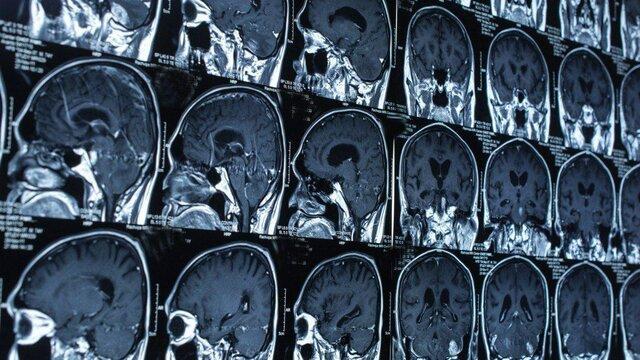 هوش مصنوعی میزان آسیب های مغزی را مشخص می نماید