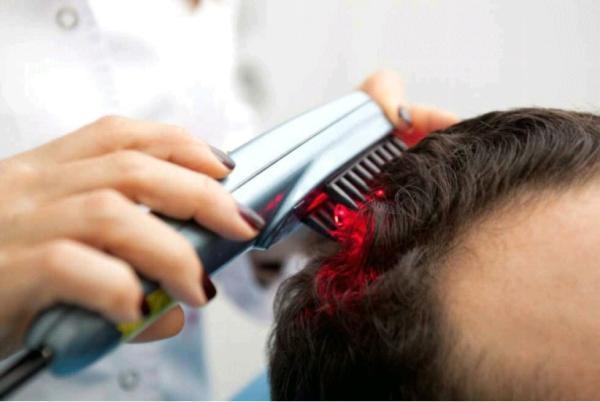 تاثیرات لیزر بعد از کاشت مو چگونه است؟